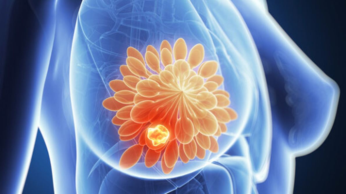 Updated Guideline For HER2 Testing In Breast Cancer Aids Physicians, Patients