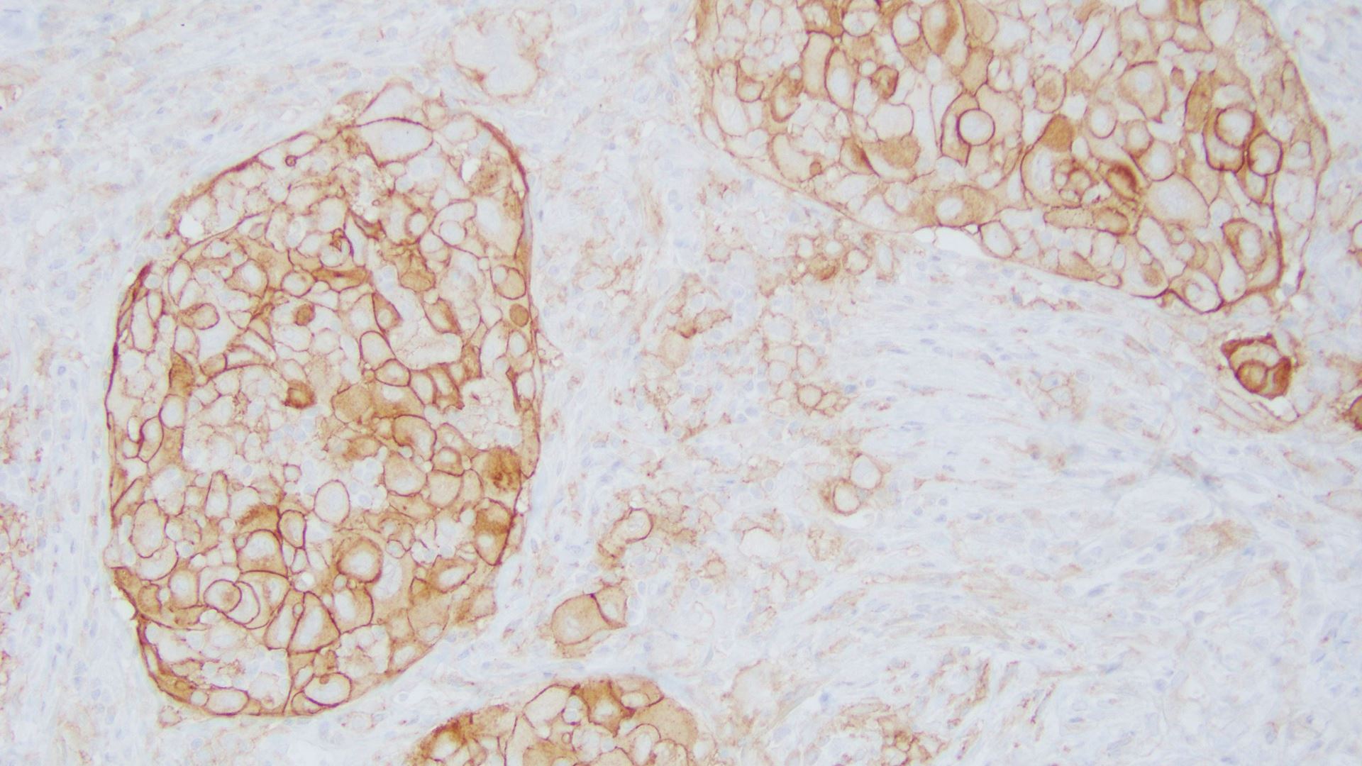 PD-L1 Lung Tumor