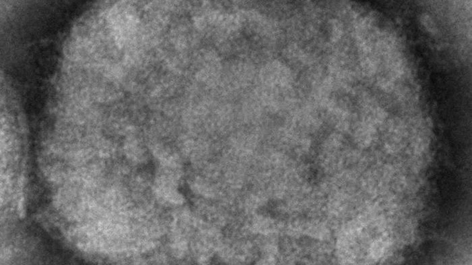 Are monkeypox scars permanent? – USA News Hub