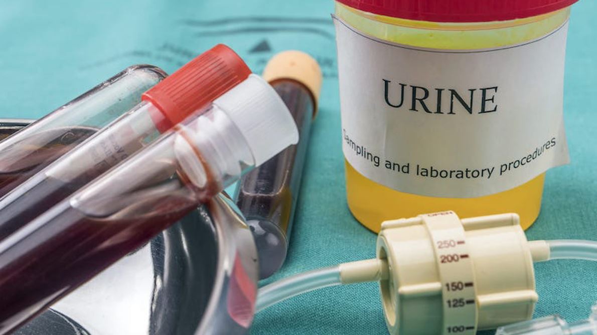 Urine-PCR