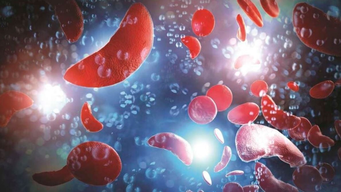 Experts urge testing for couples to curb sickle cell disease