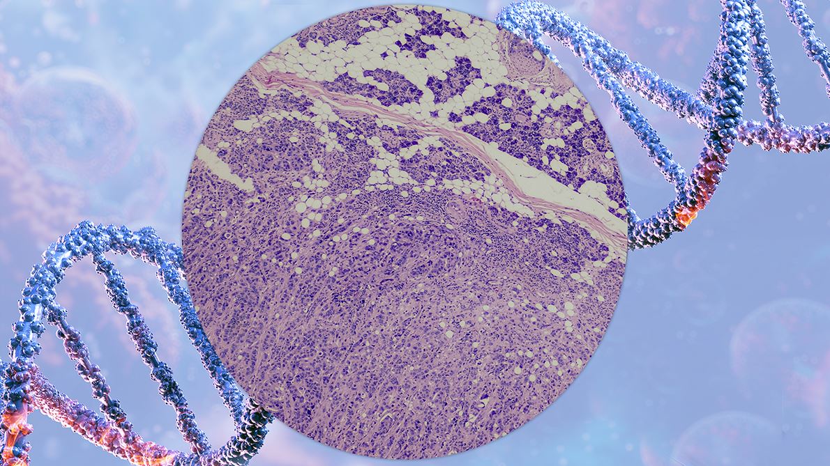 Breakthroughs in Molecular Biomarkers Transform Diagnosis and Treatment of Salivary Gland Tumors