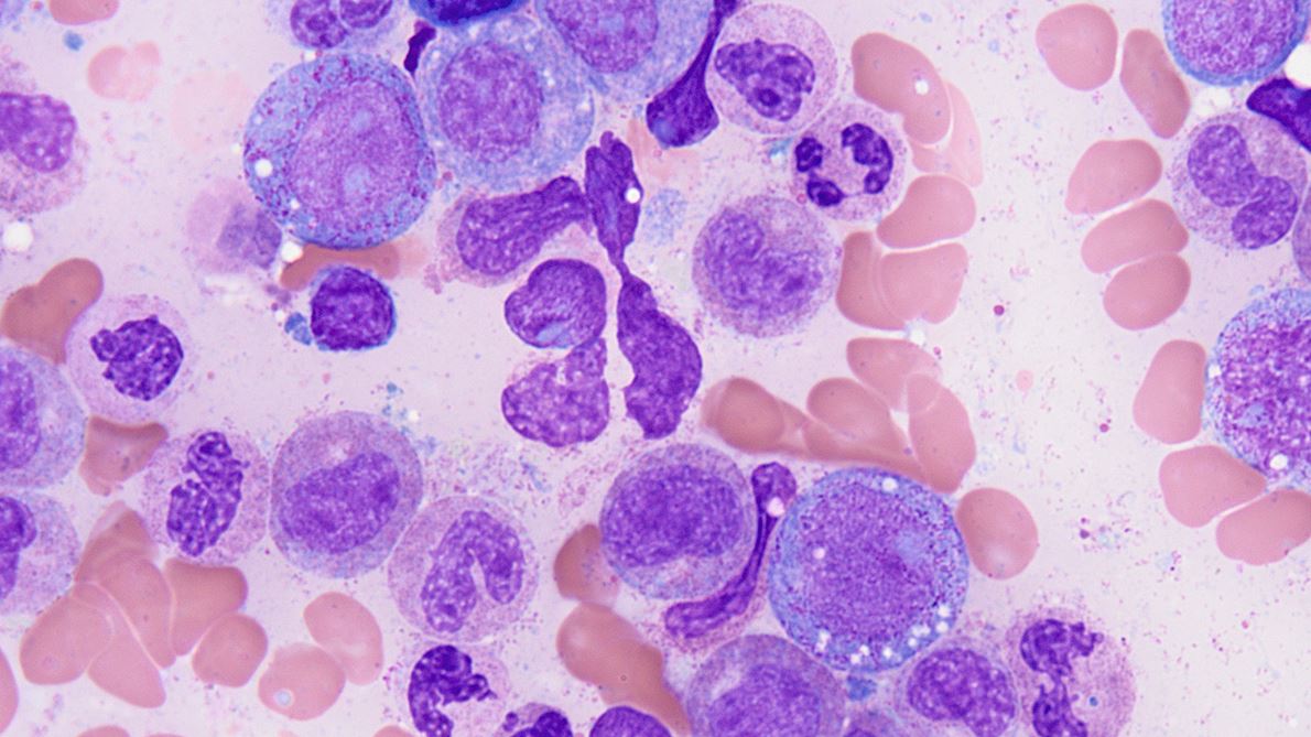 Clonal hematopoiesis of indeterminate potential
