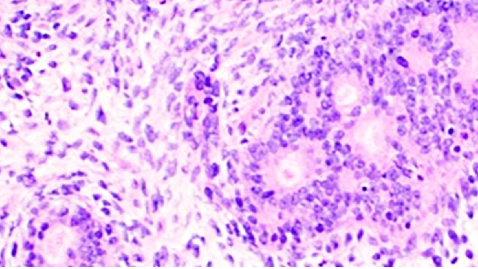 Difficult Diagnoses of Soft Tissue Tumor Aided by Immunohistochemical Surrogates