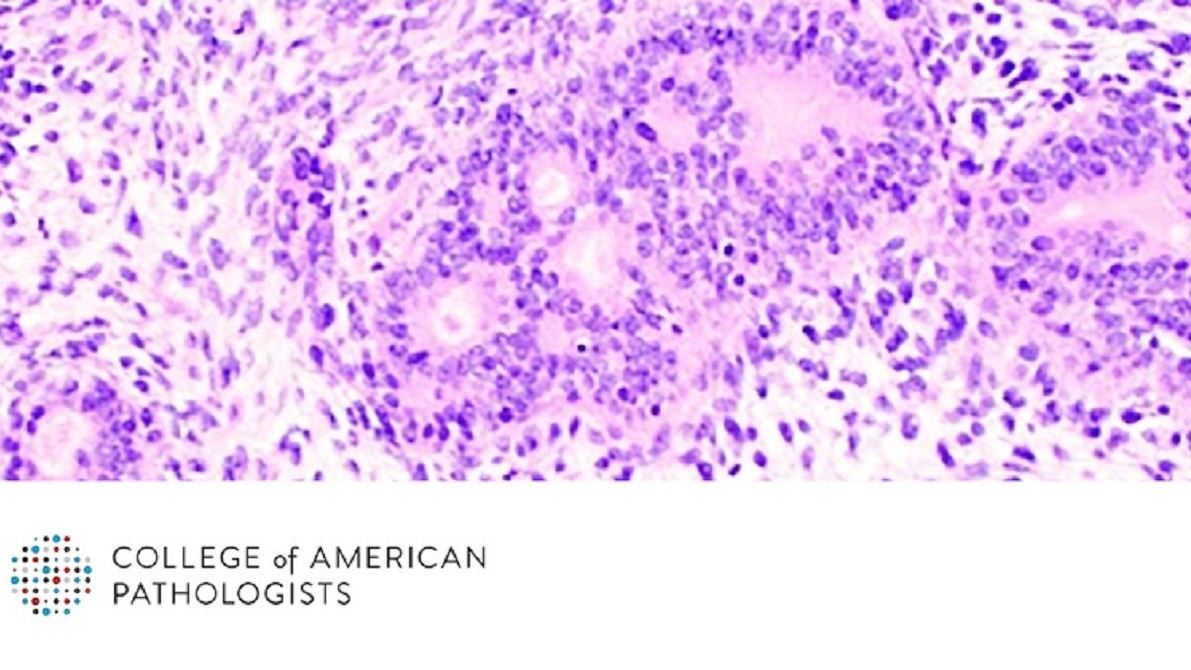 Immunohistochemistry Can Act as a Surrogate to Aid Difficult Diagnoses of Soft Tissue Tumors
