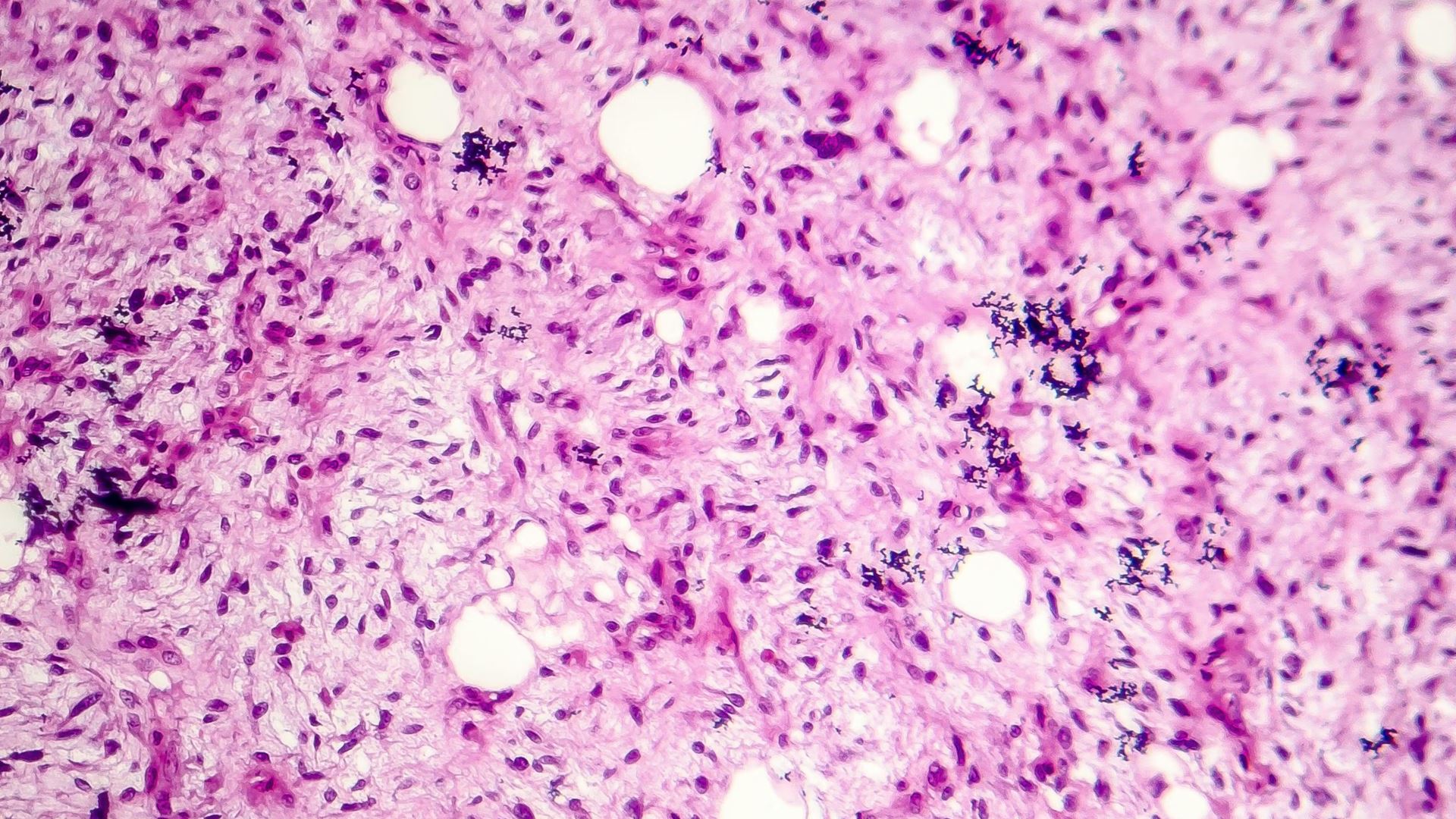 Difficult diagnoses of soft tissue tumor aided by immunohistochemical surrogates