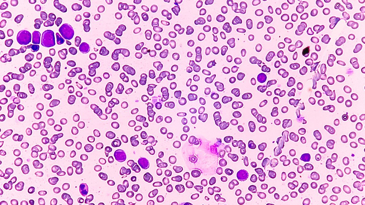 New Classifications Transform Diagnosis of Rare Blood and Bone Marrow Disorder