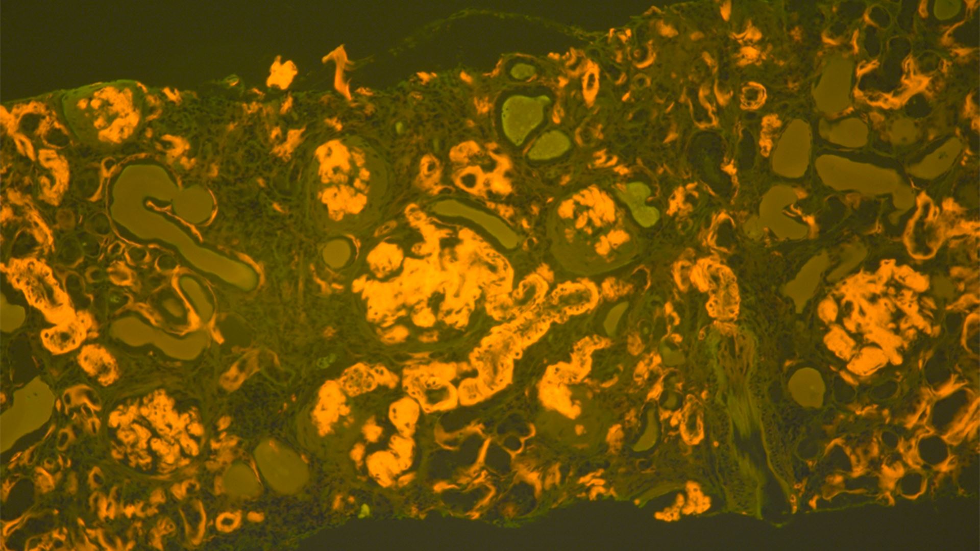 CAP Releases New Guideline to Standardize Amyloidosis Diagnosis and Improve Patient Care