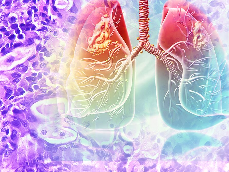 CAP Publishes Guideline for PD L1 Testing of Patients with Lung Cancer