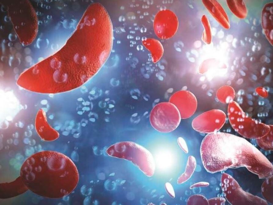 Experts urge testing for couples to curb sickle cell disease