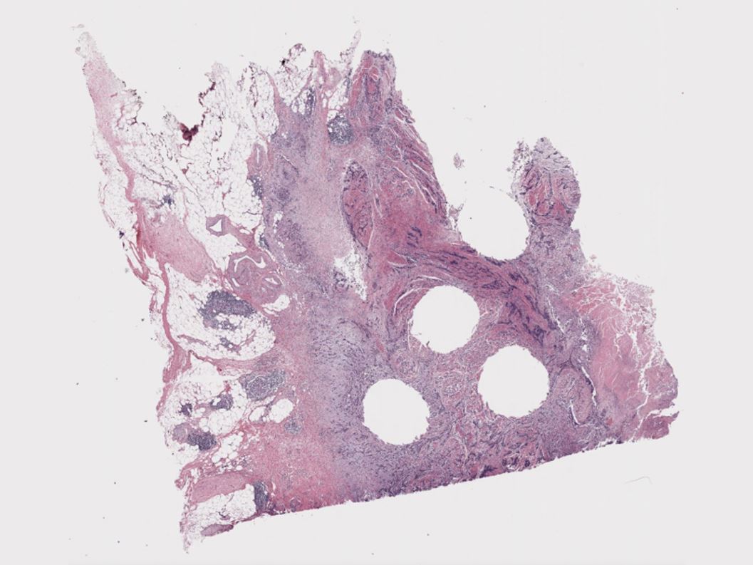 Why it s so hard to use AI to diagnose cancer