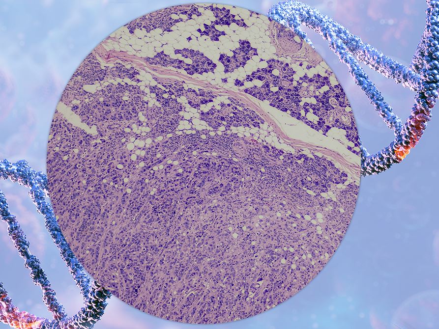 Breakthroughs in Molecular Biomarkers Transform Diagnosis and Treatment of Salivary Gland Tumors