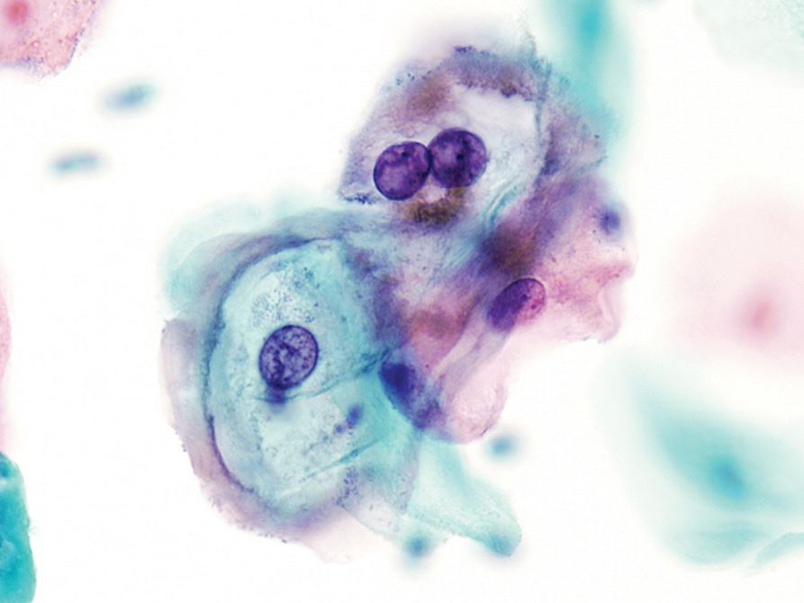 Human Papillomavirus HPV Testing in Head and Neck Carcinomas