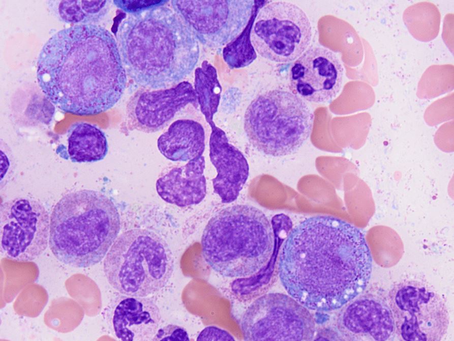 Clonal hematopoiesis of indeterminate potential