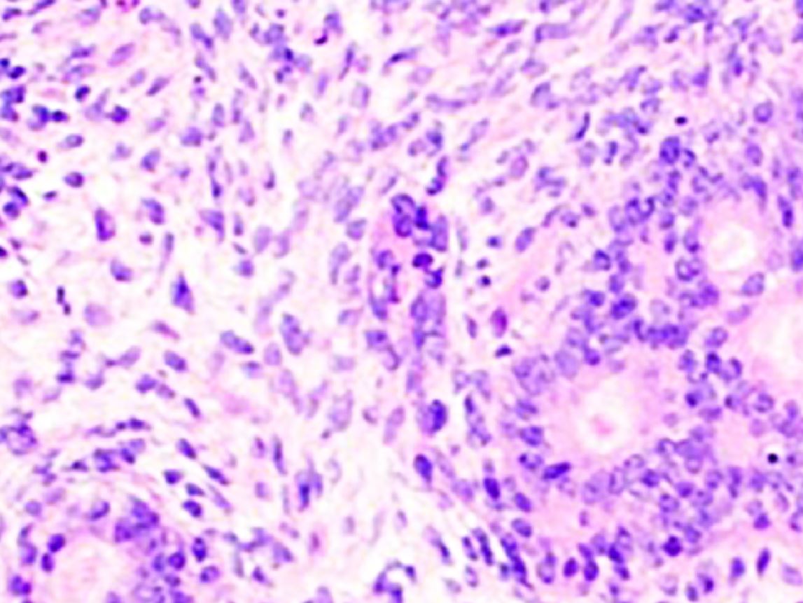 Difficult Diagnoses of Soft Tissue Tumor Aided by Immunohistochemical Surrogates