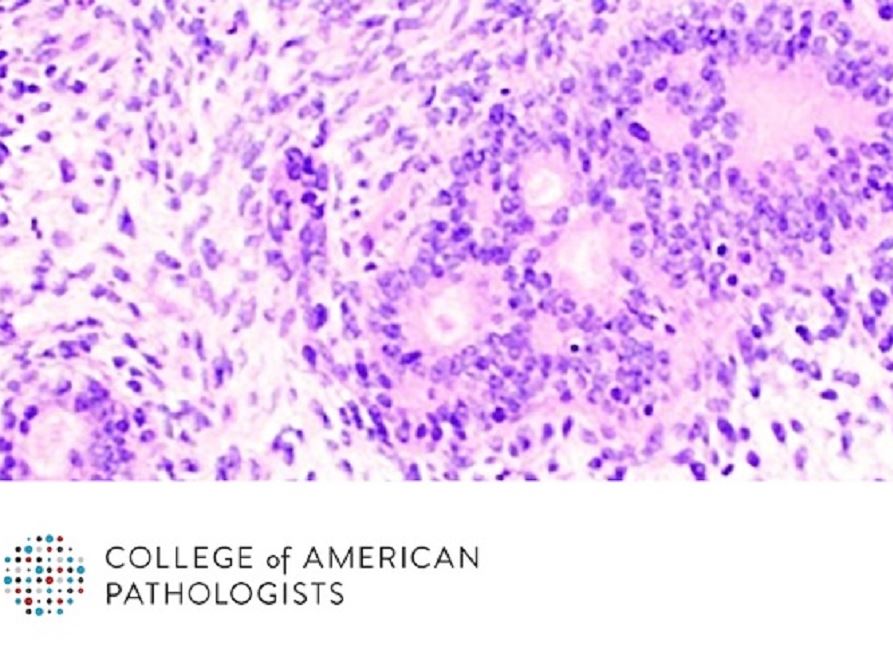 Immunohistochemistry Can Act as a Surrogate to Aid Difficult Diagnoses of Soft Tissue Tumors