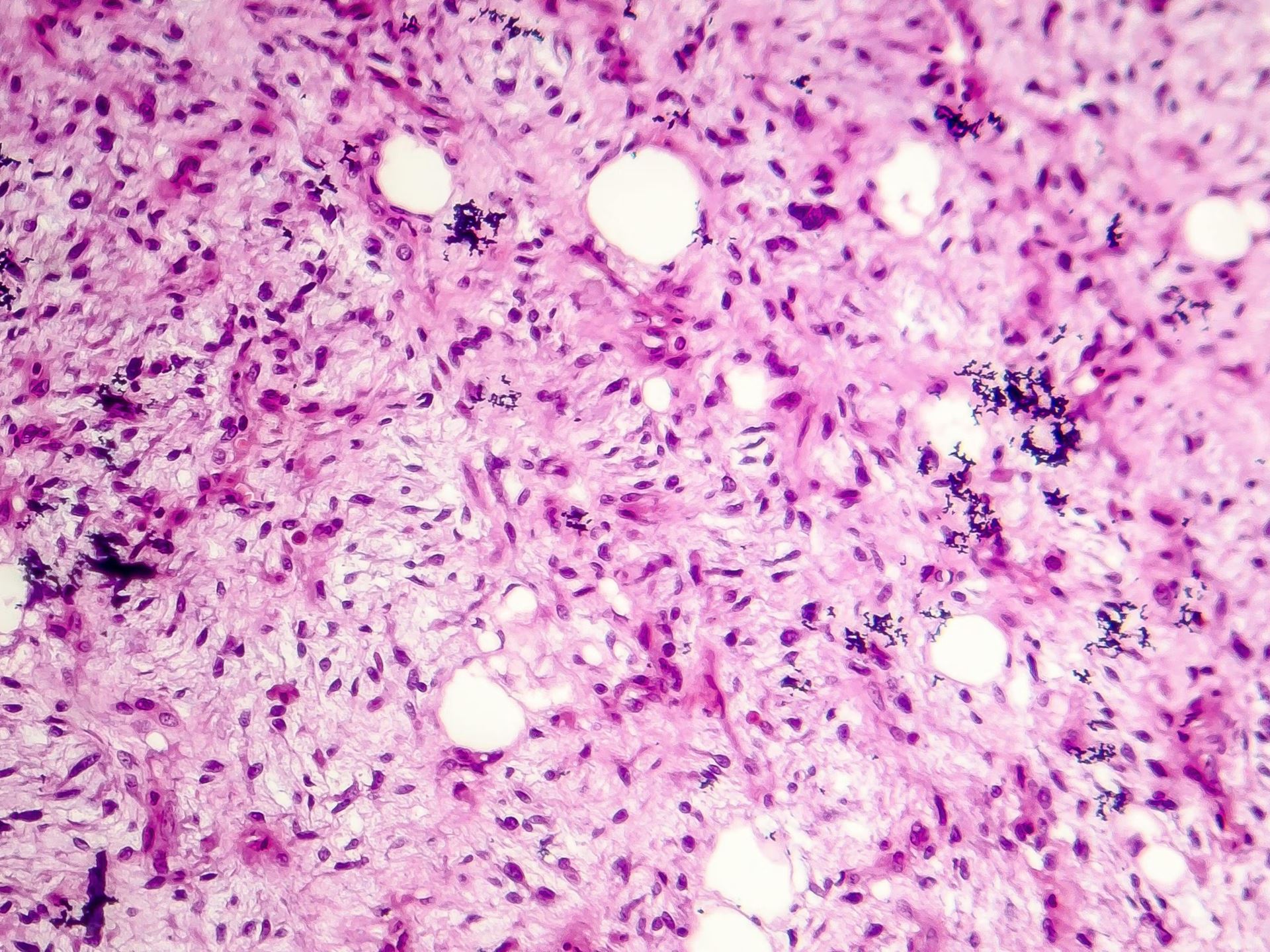 Difficult diagnoses of soft tissue tumor aided by immunohistochemical surrogates