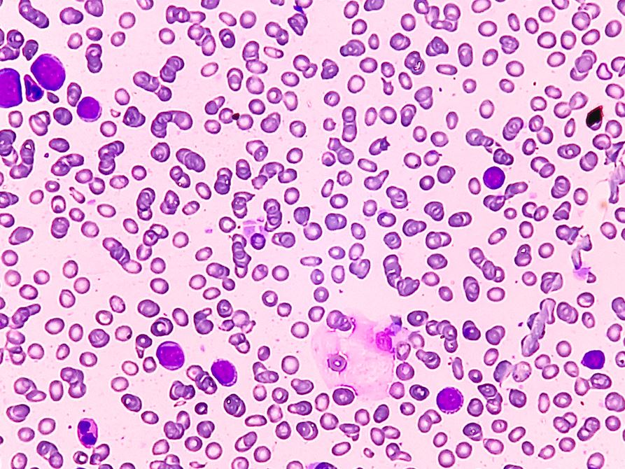 New Classifications Transform Diagnosis of Rare Blood and Bone Marrow Disorder