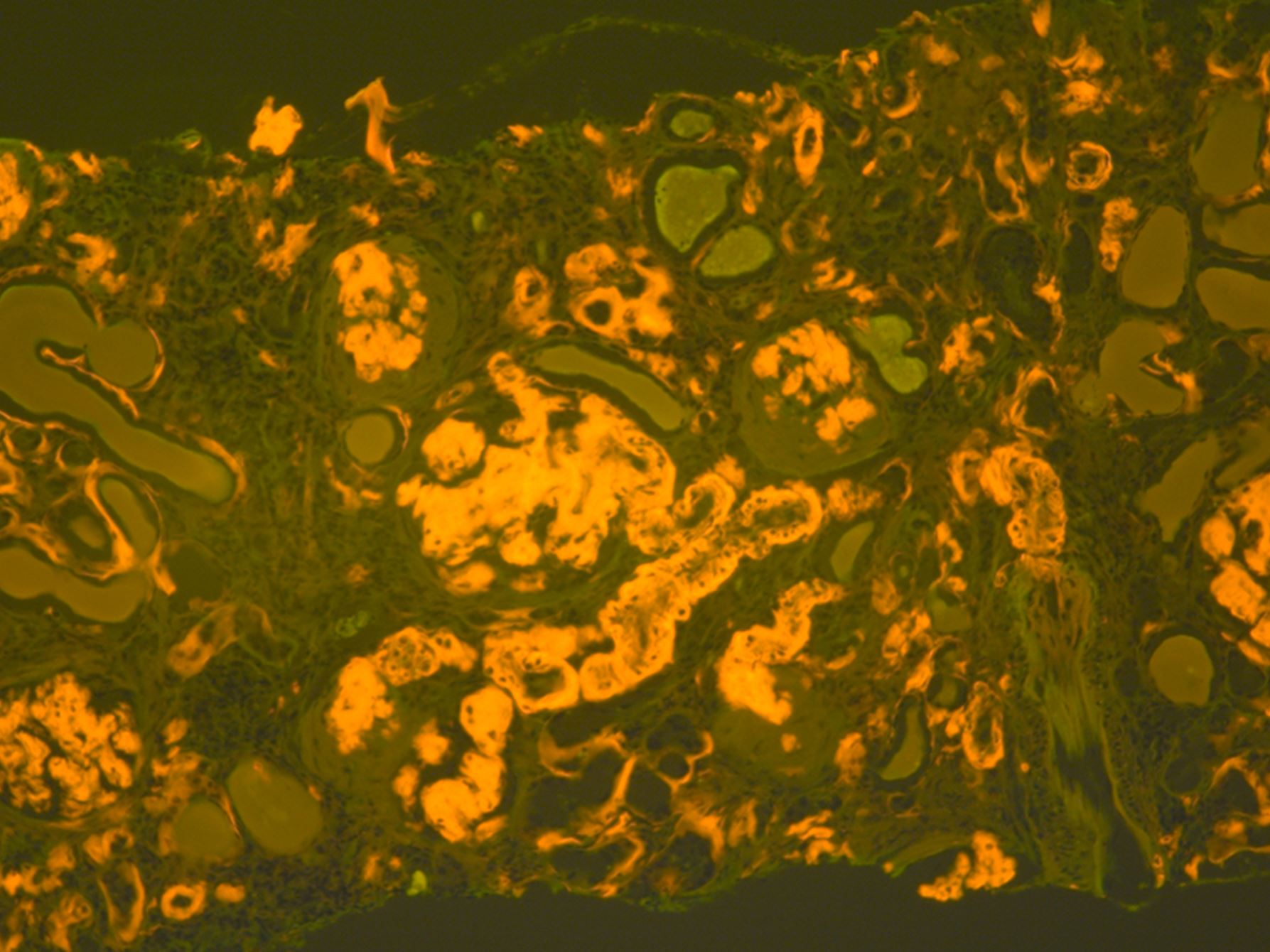 CAP Releases New Guideline to Standardize Amyloidosis Diagnosis and Improve Patient Care