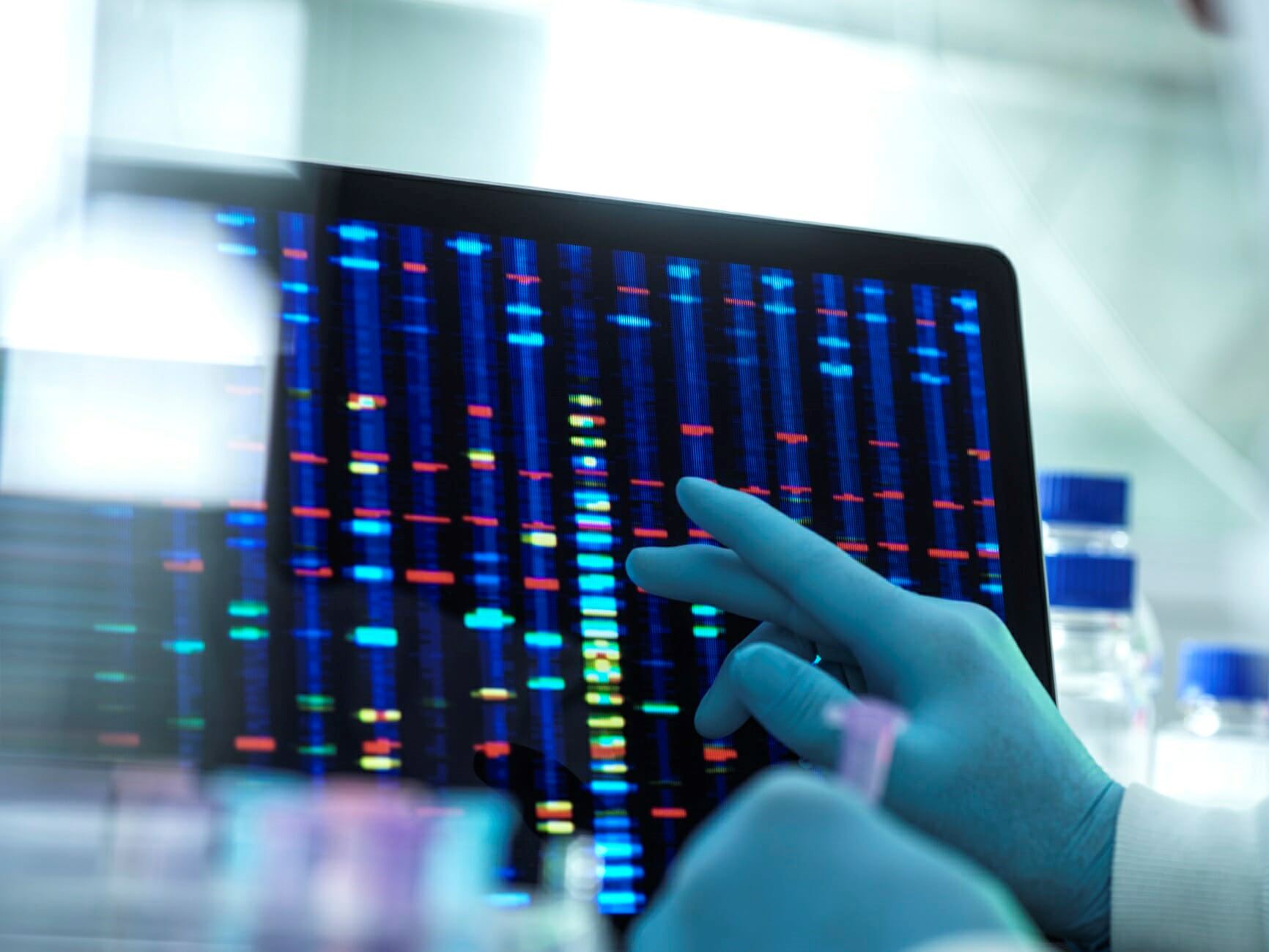 Donor Derived Cell Free DNA May Aid Monitoring of Kidney Transplant Recipients