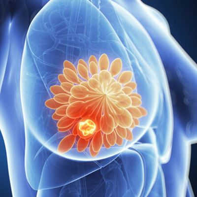 Updated Guideline For HER2 Testing In Breast Cancer Aids Physicians, Patients