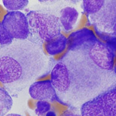 Specialty Physician Groups Publish Guideline To Improve Care For Acute Leukemia Patients