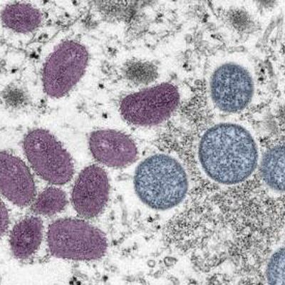 Georgia ranks 3rd nationwide in per capita monkeypox cases. Atlanta is a hotspot