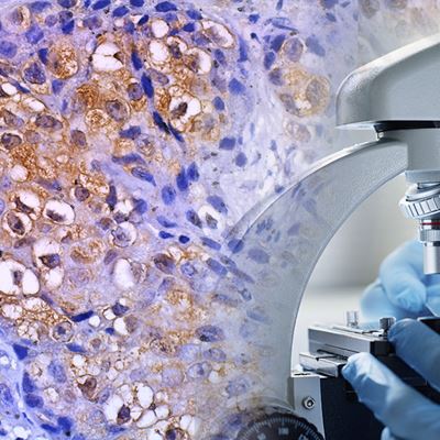 CAP Updates Validation of Immunohistochemical Assays Testing Guideline for Precise Results Improved Patient Care