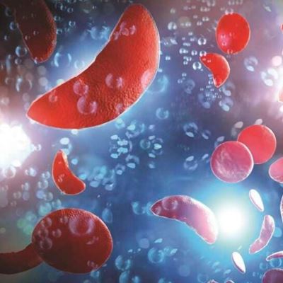 Experts urge testing for couples to curb sickle cell disease