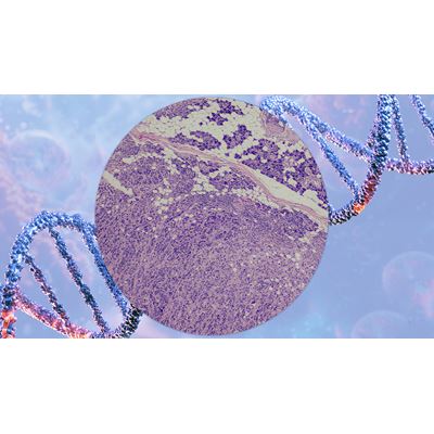 Breakthroughs in Molecular Biomarkers Transform Diagnosis and Treatment of Salivary Gland Tumors