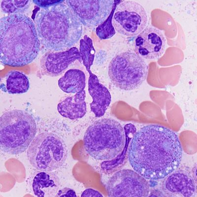 Clonal hematopoiesis of indeterminate potential
