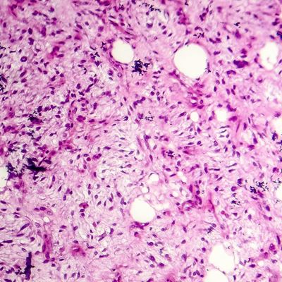 Difficult diagnoses of soft tissue tumor aided by immunohistochemical surrogates