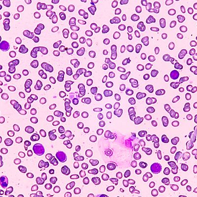 New Classifications Transform Diagnosis of Rare Blood and Bone Marrow Disorder