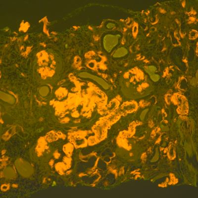 CAP Releases New Guideline to Standardize Amyloidosis Diagnosis and Improve Patient Care