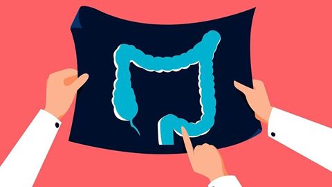 IBS or Cancer? Digestive Issues That Might Signify Colorectal Cancer