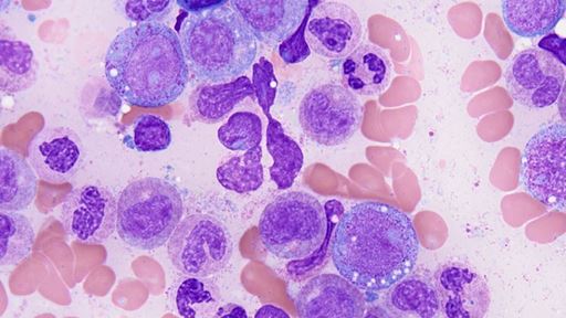 Clonal hematopoiesis of indeterminate potential