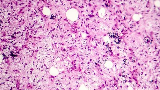 Difficult diagnoses of soft tissue tumor aided by immunohistochemical surrogates