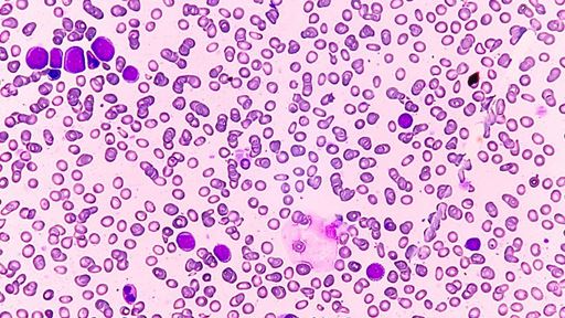 New Classifications Transform Diagnosis of Rare Blood and Bone Marrow Disorder