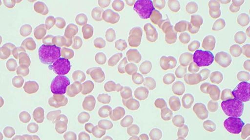 Team discovers how to target 'undruggable' protein that fuels aggressive leukemia