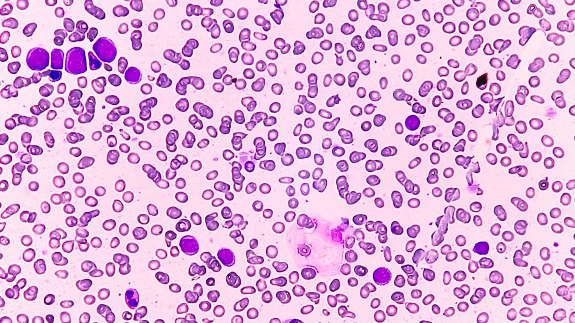 New Classifications Transform Diagnosis of Rare Blood and Bone Marrow Disorder