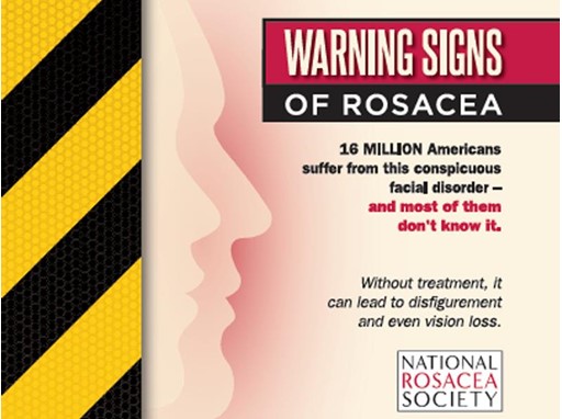 Warning Signs of Rosacea